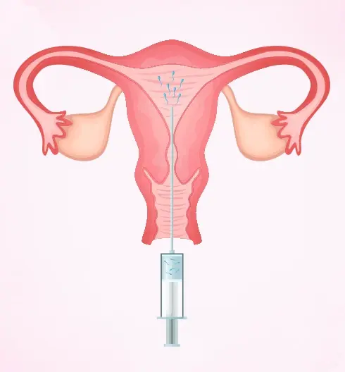 Infertility Consultation