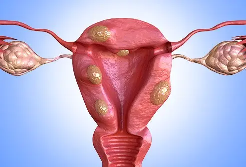 Myomectomy and Fibroid Removal