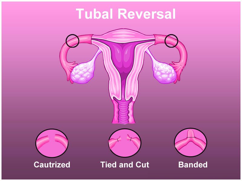 Tubal Ligation Reversal